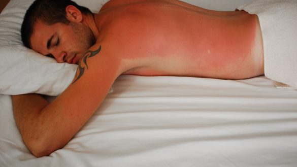 Solskader og aktinisk keratose, diagnose og behandling. Forebyggelse